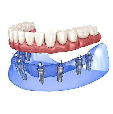 Ilustración de una restauración con implante dental / Illustration of a dental implant restoration
