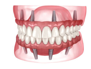 All Smiles Dental – Your Trusted Clinic for Dental Implants in Bromley.