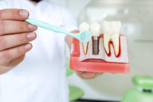 All Smiles Dental – Your Trusted Clinic for Dental Implants in Bromley.