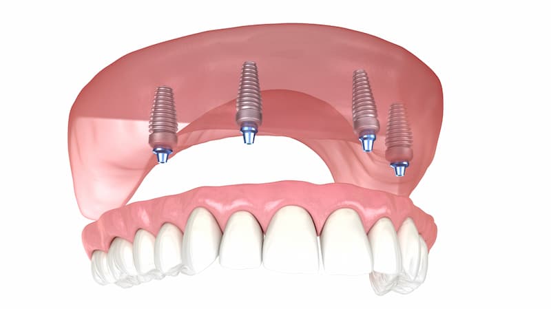 Dentist In Cancun, Mexico | Cosmetic & General Dentistry
