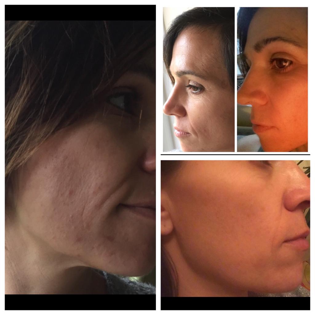 Tattoo removal Bognor Regis | Laser hair removal Bognor Regis