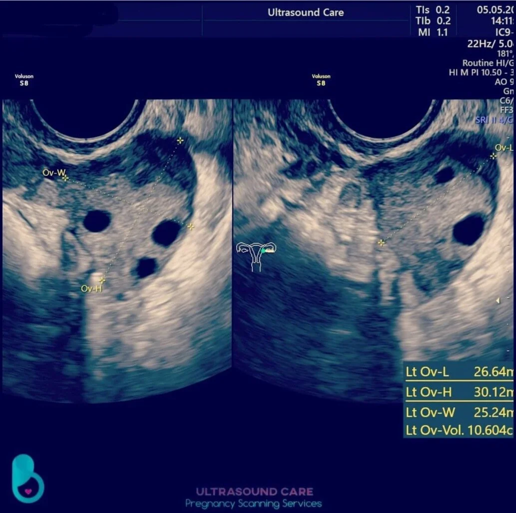 Ultrasound image displayed at Ultrasound Care in Liverpool